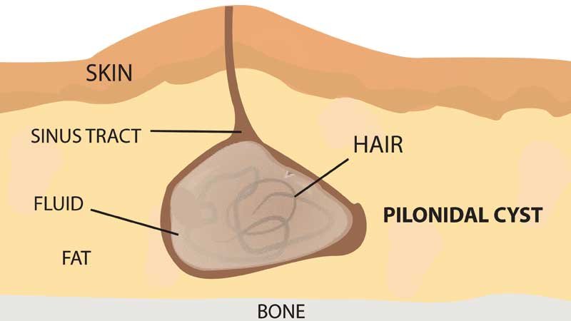 pilonidal-sinus