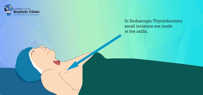 Endoscopic Thyroid Surgery - Small Incisions made at the axilla