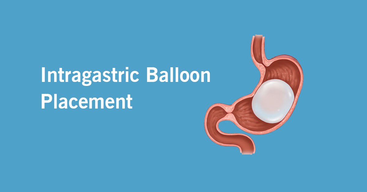 Intragastric Balloon Placement for Weight Loss Keyhole Clinic Kochi