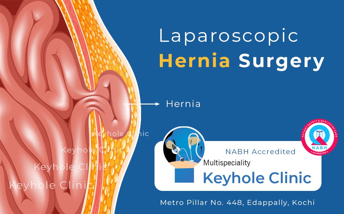 Hernia Surgery in Kerala - Laparoscopic Hernia Surgery, Open Hernia Surgery. Laparoscopic Hernia Surgery is performed through keyhole incisions and can be performed for inguinal hernia, femoral hernia, epigastric hernia, umbilical hernia, hiatal hernia, incisional hernia. Get consulted by Best Hernia Surgeons in Kochi, Kerala