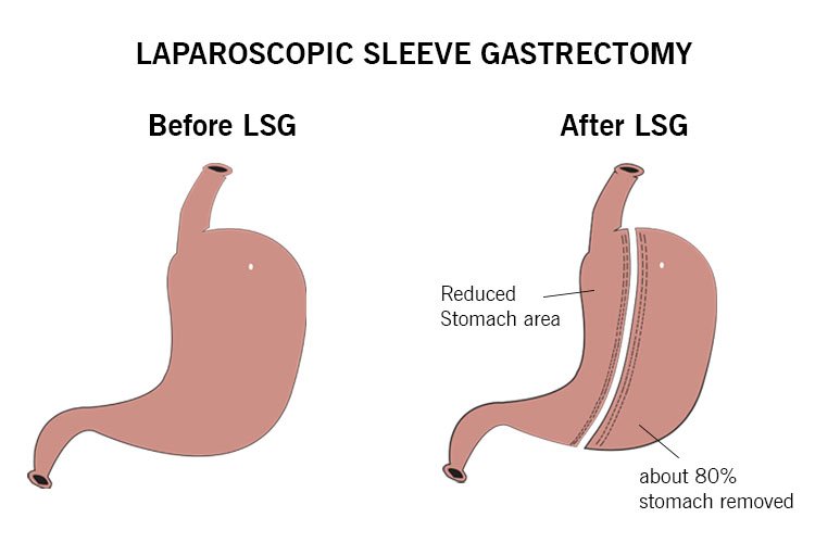 Laparoscopic Sleeve Gastrectomy