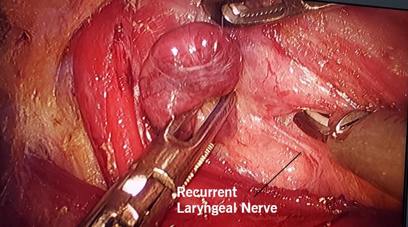 Recurrent Laryngeal Nerve Visualized on Endoscopic Thyroidectomy