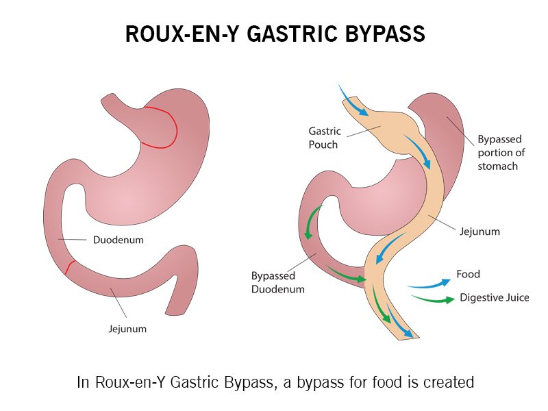 Roux-en-Y Gastric Bypass Surgery