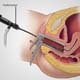 Laparoscopoic Hernia Surgery