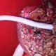 Living Donor Liver Transplant