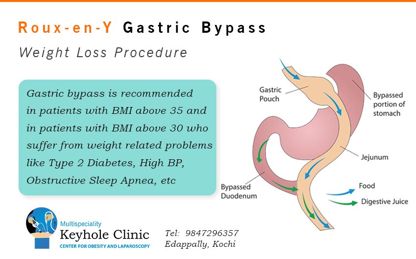 Roux-en-Y Gastric Bypass for Weight Loss