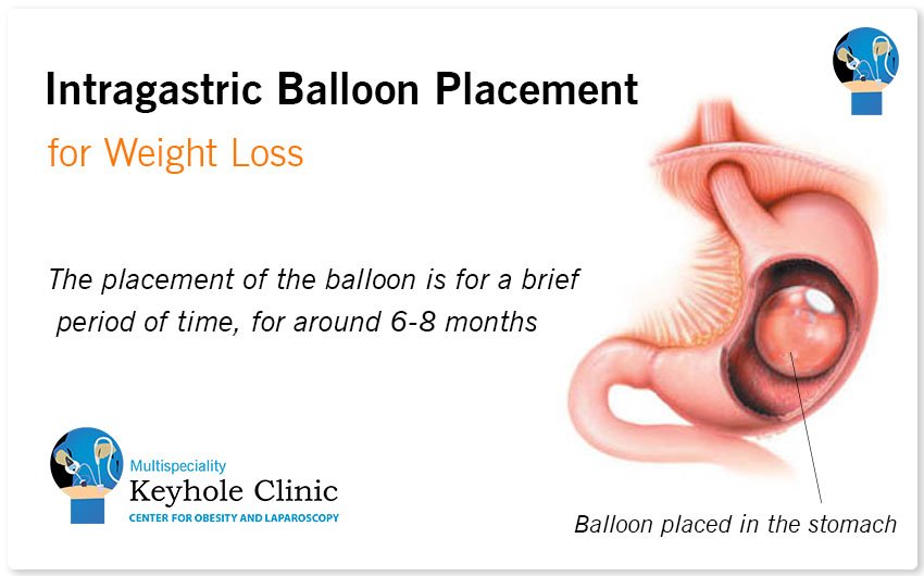 Intragastric Balloon Placement for Weight Loss