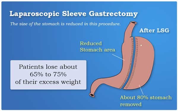Laparoscopic Sleeve Gastrectomy for Weight Loss