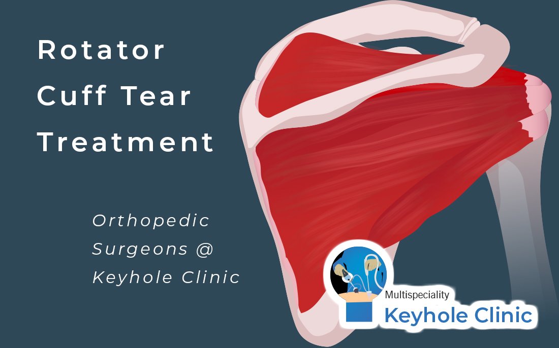 Rotator cuff Tear Treatment in Kochi. Best Doctors specializing in Rotator cuff Tear include Dr. Dennis P Jose, Dr. Mohamed Rafeeq, and Dr. Suhanesh Haridas