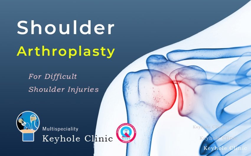 Shoulder Arthroplasty or Shoulder Replacement is a procedure for treating severe shoulder pain and stiffness that results from various forms of arthritis or degenerative joint disease or difficult injuries of the shoulder joint. Keyhole Clinic has Best Orthopedic Surgeons performing Shoulder arthroplasty.