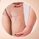 Varicose Vein Treatment