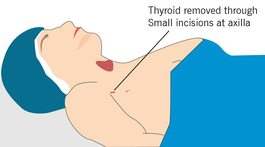 Endoscopic Thyroidectomy in Kerala