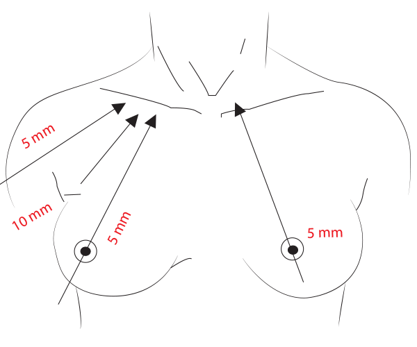 ABBA (Axillo-Bilateral Breast Approach)