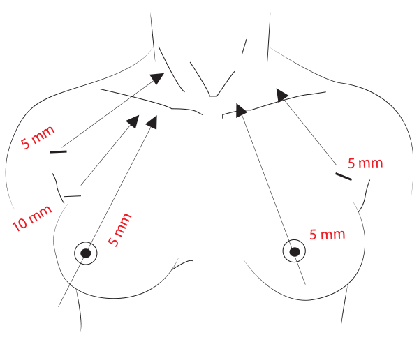 BABA (Bilateral Axillo-Breast Approach)