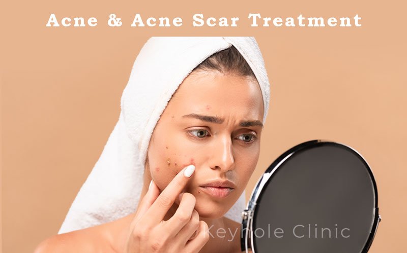 Acne and Acne Scar Treatment at Edappally, Keyhole Clinic