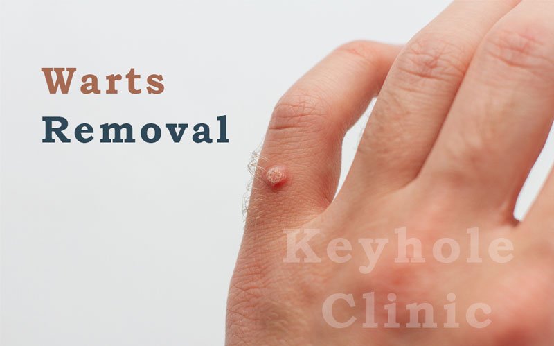 Warts Removal at Edappally Keyhole Clinic 
