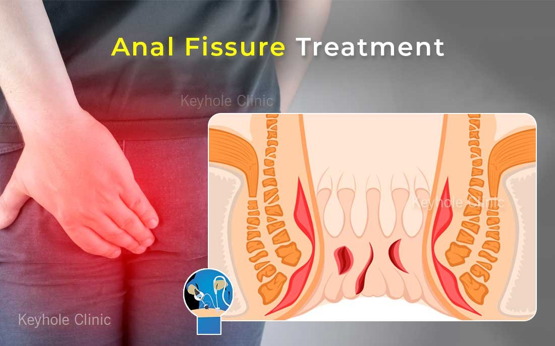 Anal Fissure Treatment in Kochi.  Treatment Options - Lateral Internal Sphincterotomy (LIS), Anal Dilatation, LASER Ablation, Medications