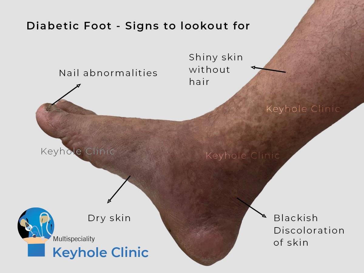 Any foot pathology in a diabetic patient can be called a diabetic foot including minor foot diseases like nail abnormalities, dry skin, blackish discoloration of the skin, shiny skin without hair to life threatening conditions like necrosis and gangrene.