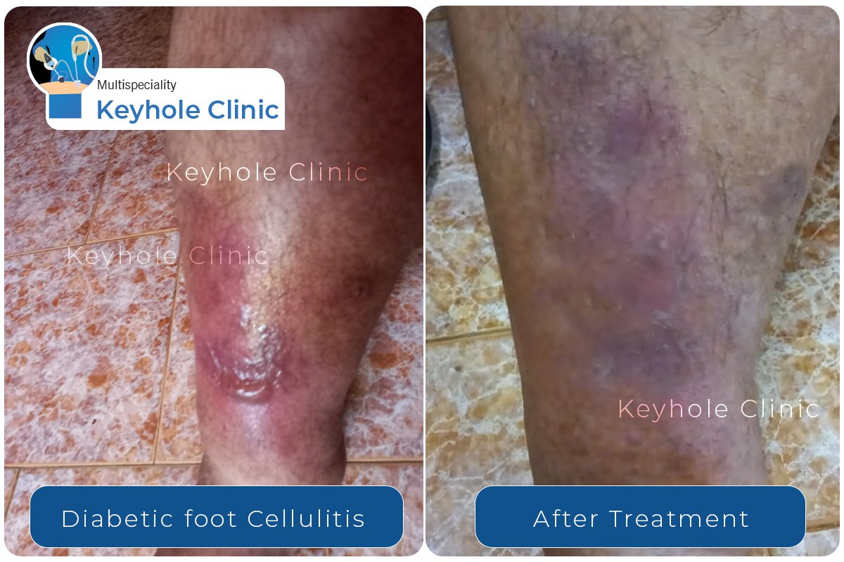 Diabetic foot cellulitis