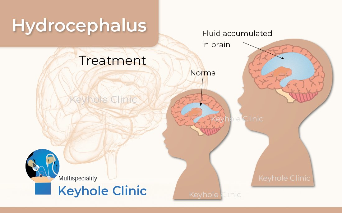 Hydrocephalus Treatment in Kochi. Dr. Sudish Karunakaran is one of the Best Surgeon for Hydrocephalus Treatment. Treatment includes Ventriculoperitoneal Shunt (VP Shunt), Endoscopic Third Ventriculostomy (ETV Surgery).