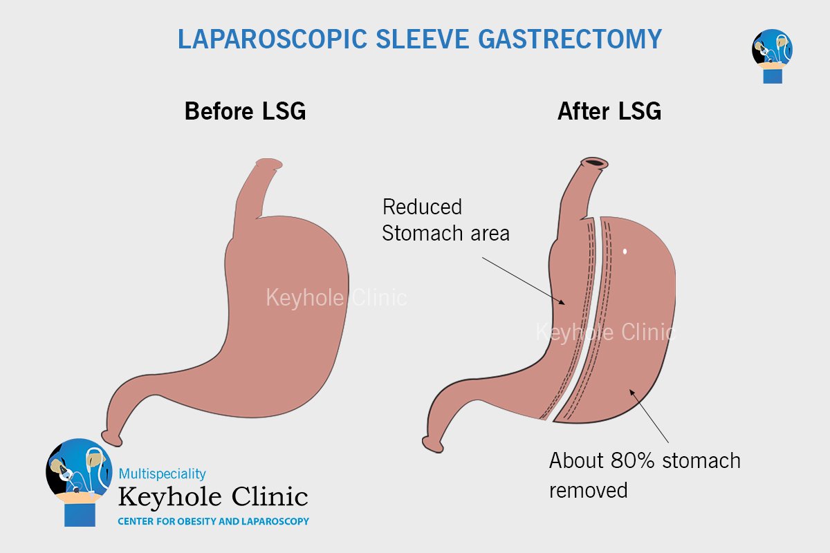 Laparoscopic Sleeve Gastrectomy is a type of Bariatric Surgery where the stomach is reduced to about 15% of the original size of the stomach. It is a very common procedure for weight loss and is performed regularly in Kerala.