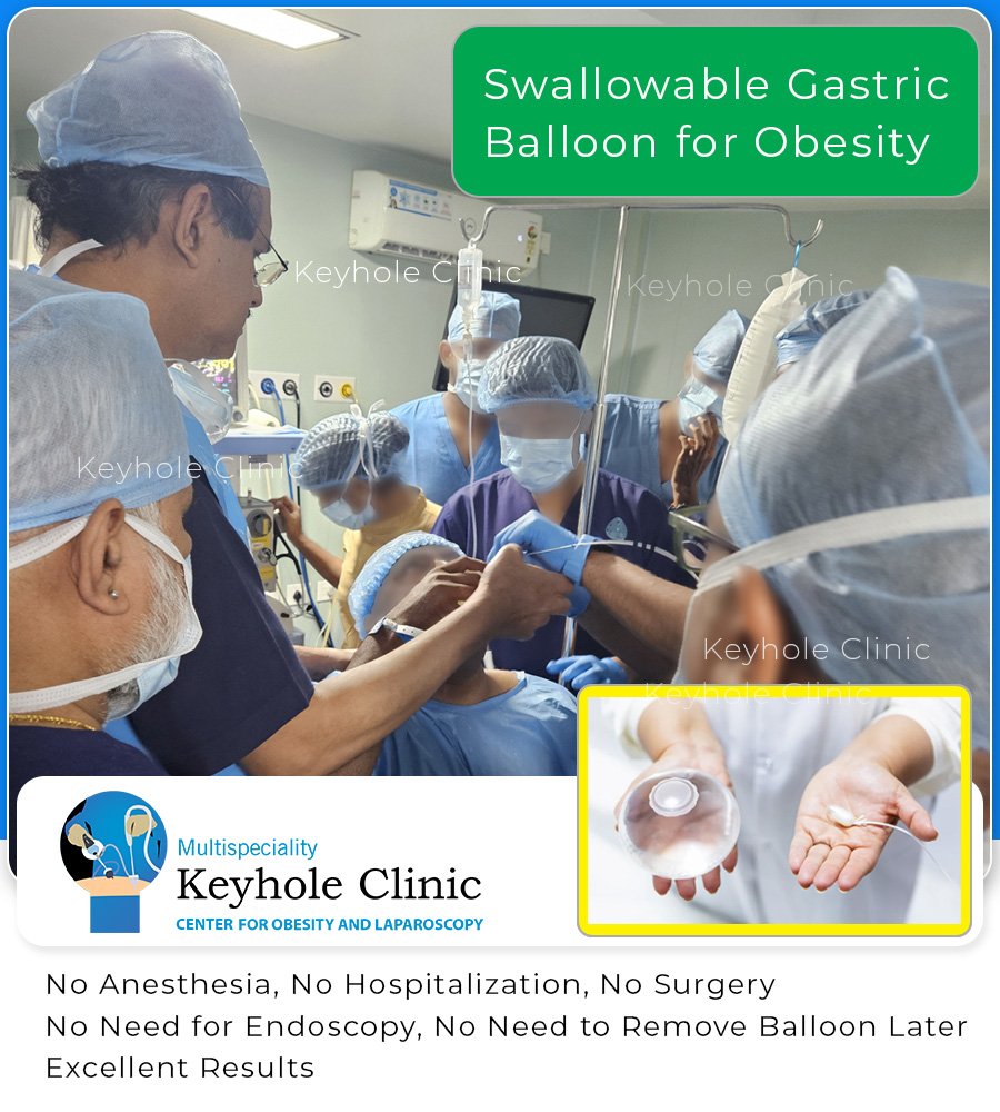 Swallowable Gastric Balloon for Obesity.