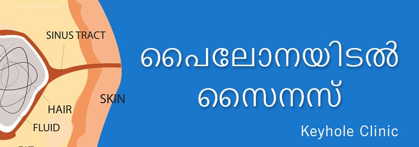 പൈലോനയിടൽ സൈനസ് ചികിത്സ