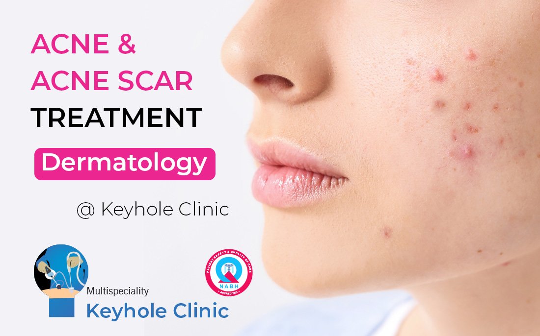 Acne Treatment and Acne Scar Treatment in Kochi. Dermatology Skin Clinic at Keyhole Clinic has best dermatogist providing medical treatment, Chemical peels, Procedural treatment for Acne