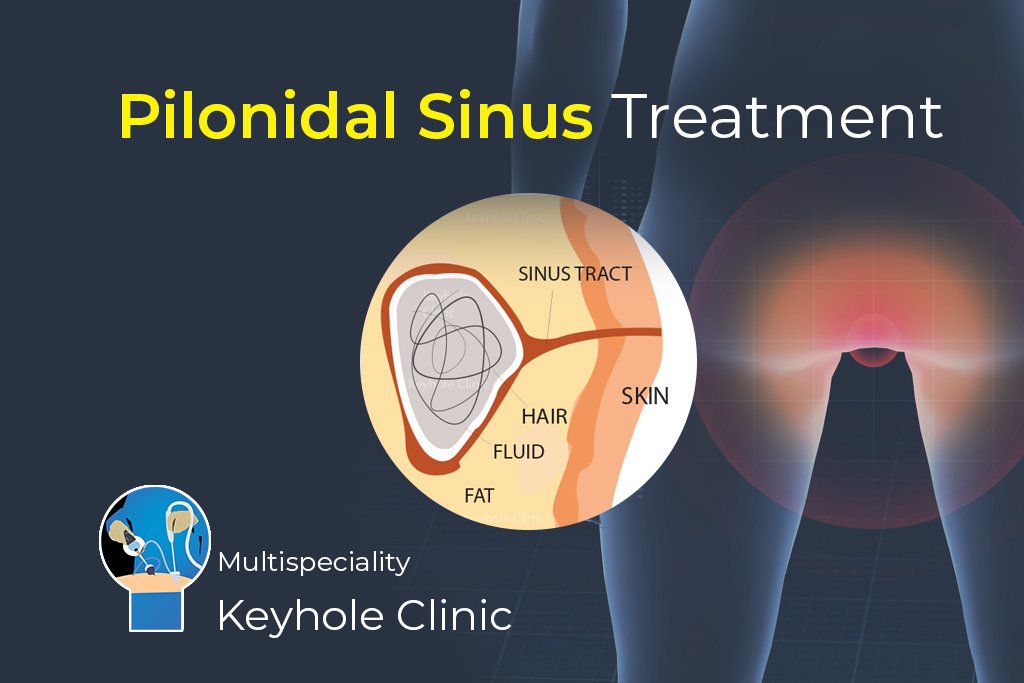 Pilonidal Sinus Treatment Options - Excision, Endoscopic
Pilonidal Sinus Treatment (EPSiT), LASER ablation of Pilonidal Sinus (LAPS), Video-assisted
LASER Ablation of the Pilonidal Sinus (VALAPS)
