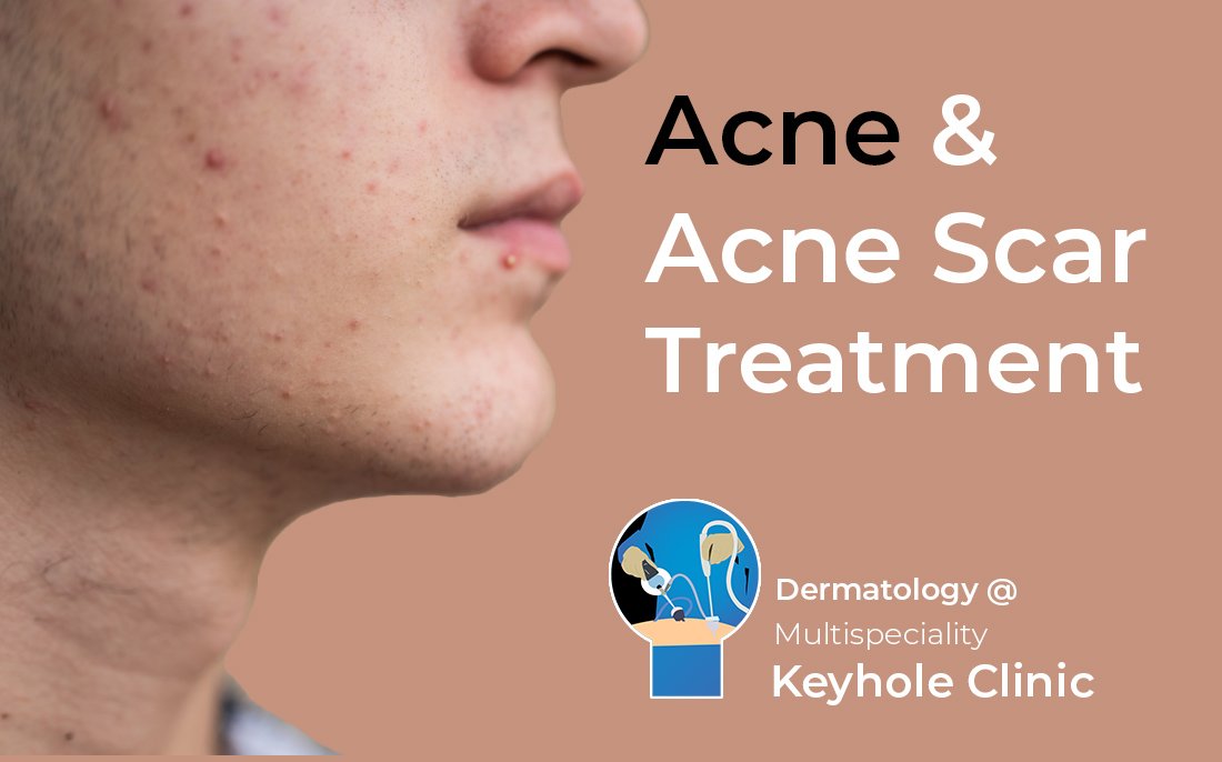 Acne Treatment by Dermatologist available at Keyhole Clinic 