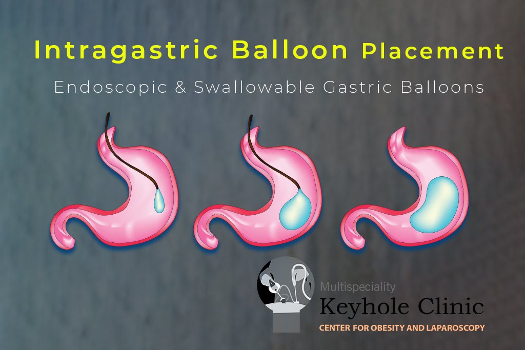 Bariatric Surgery 