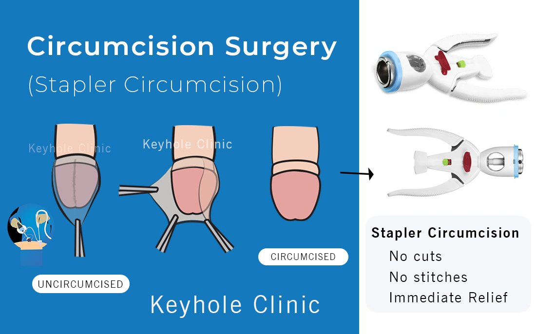 Circumcision Surgery in Kochi - Stapler Circumcision specialist in Edappally