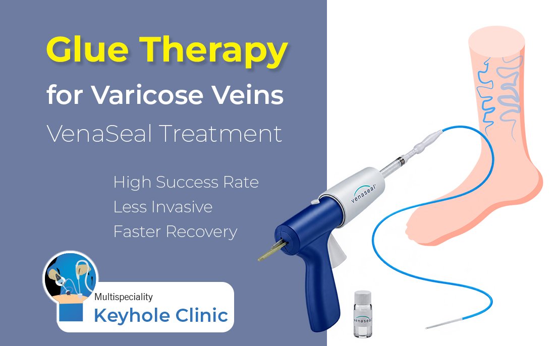 Glue Therapy for Varicose Veins Treatment in Kochi - VenaSeal Treatment
