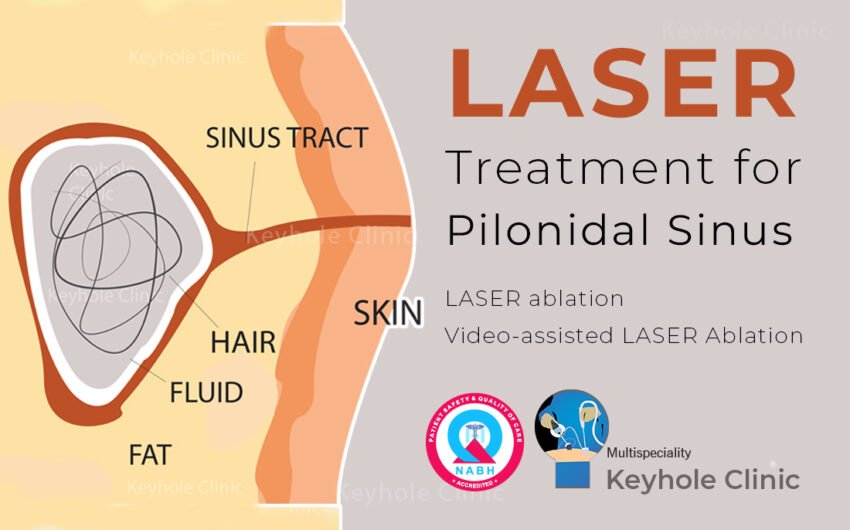 LASER Treatment for Pilonidal Sinus in Kochi, Edappally