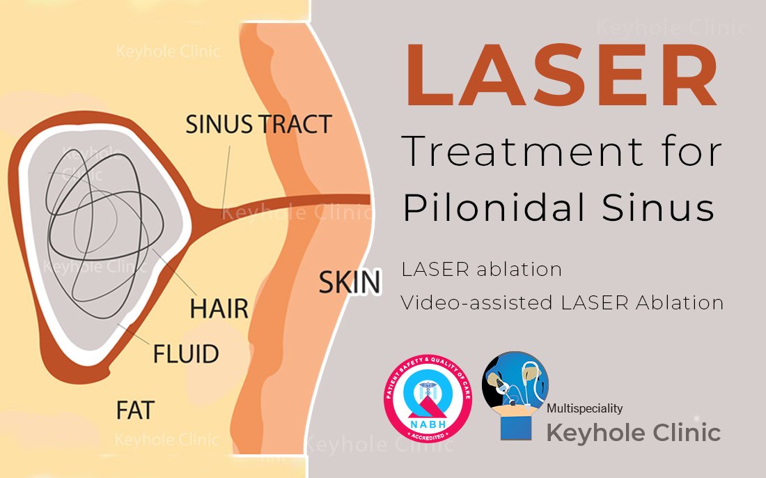 LASER Treatment for Pilonidal Sinus in Kochi, Edappally